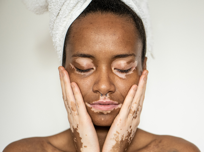 Portrait of young Brazilian woman with Vitiligo on face and hands, close up of details of mouth, closed eyes and curly hair, white background, copyspace