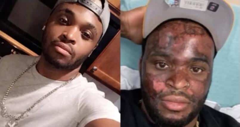 Neyo White went viral after a trip to a chemical peel from Georgia spa turned into a nightmare.