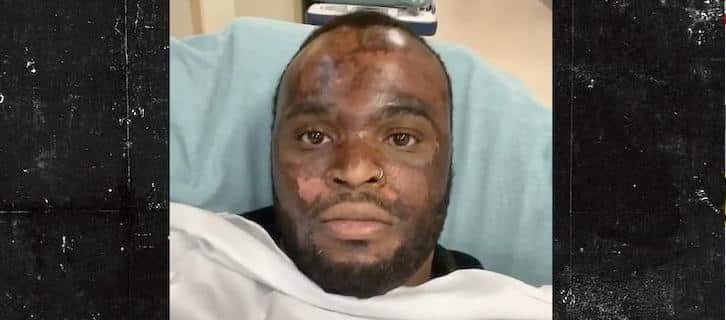 Neyo White (burns) - screenshot - Chemical Peel Victim